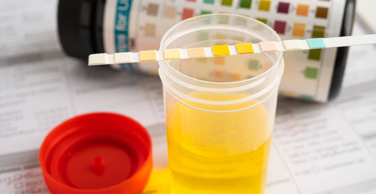 Glucose in Urine Symptoms, Test, Causes & Treatment